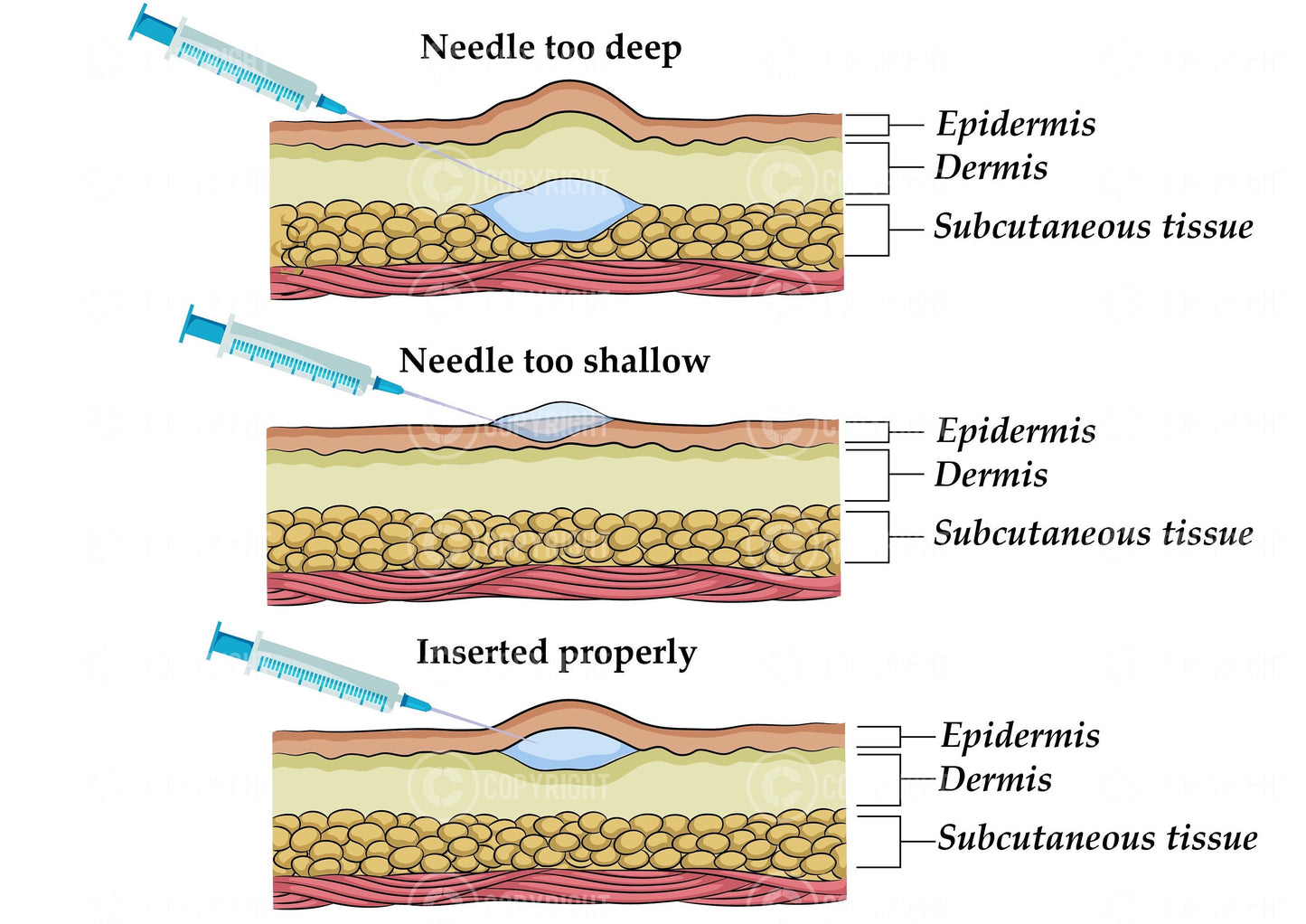 Intradermal Injection technique|  mesotherapy | skin boosters |Botox & Filler Injector | Aesthetics | Dermatology | Medspa| Digital Download