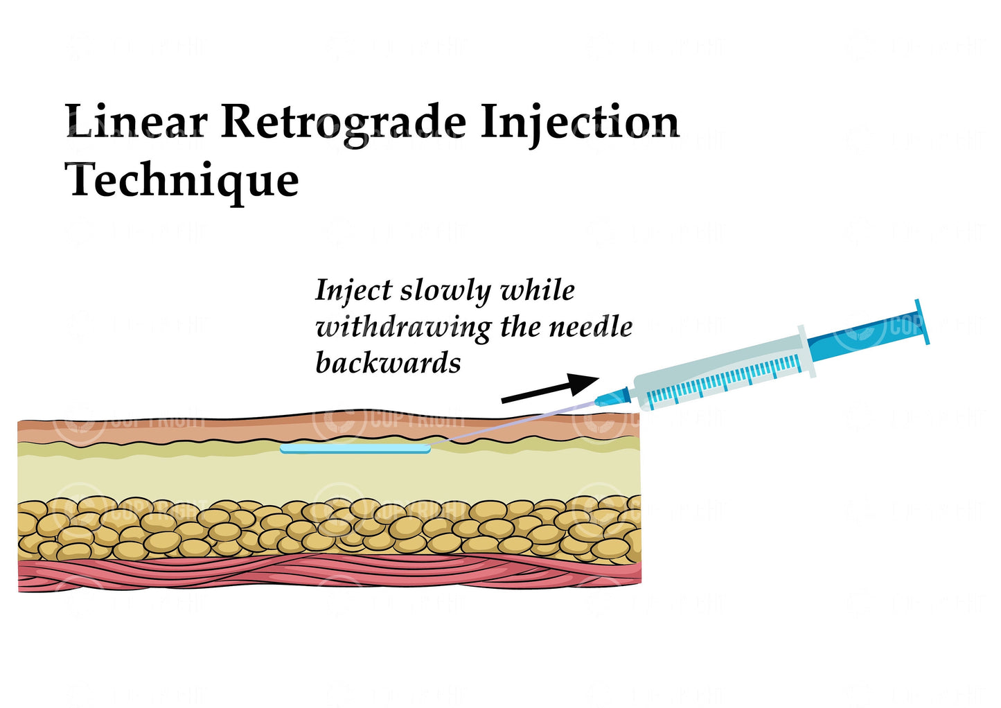 Linear retrograde injection technique |Botox & Filler Injector | Anatomy | Aesthetics | Dermatology | Medspa| Digital Download