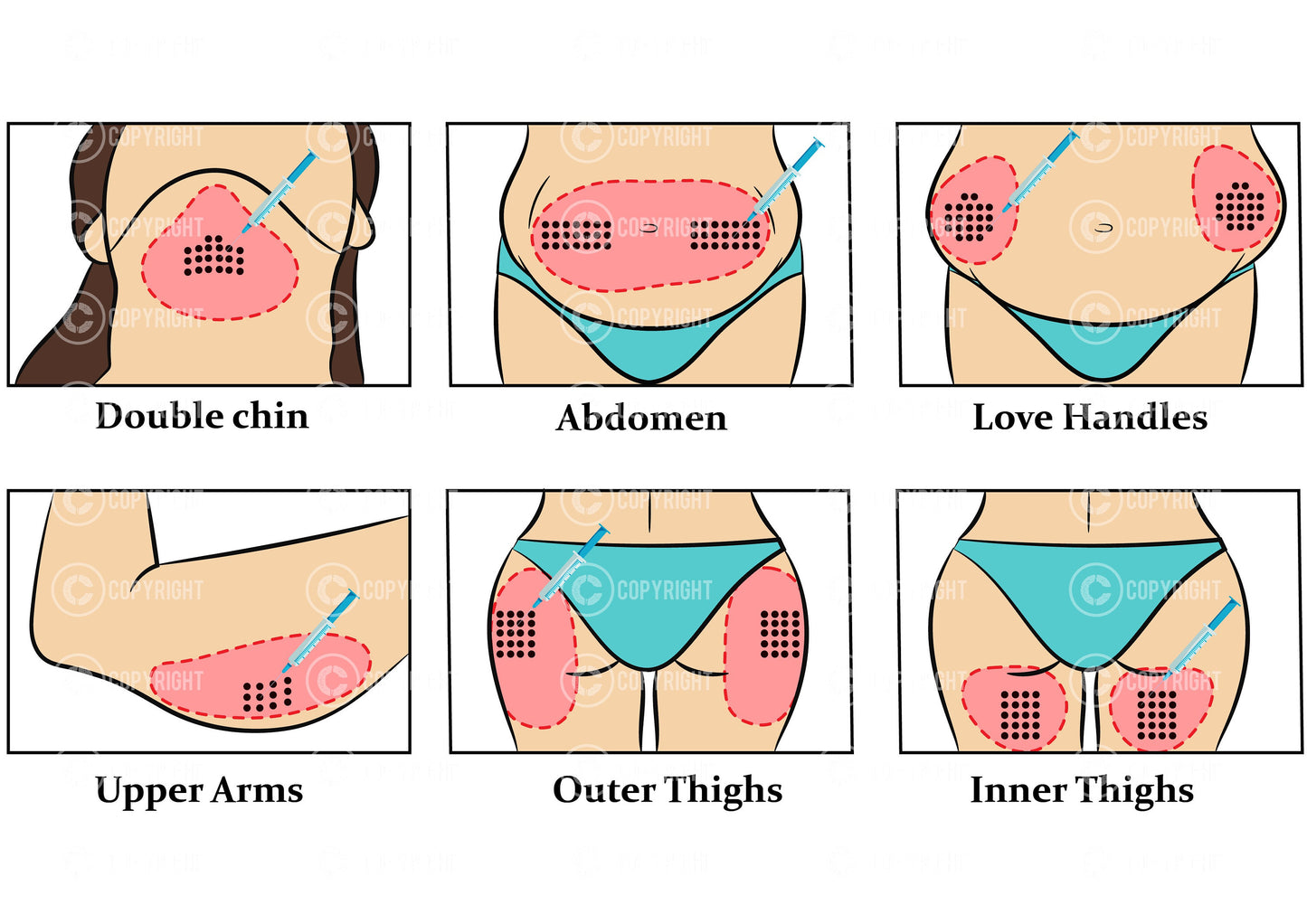 Fat Dissolving injection pattern | Aqualyx | Deso | Lipolab | Botox & Filler | Anatomy | Aesthetics | Dermatology | Medspa| Digital Download