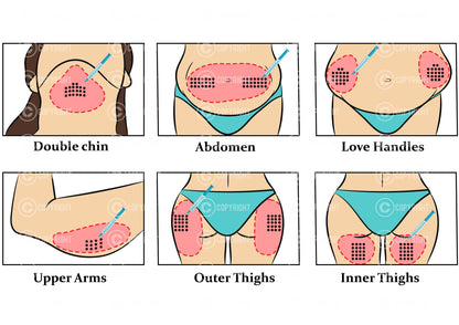 Fat Dissolving injection pattern | Aqualyx | Deso | Lipolab | Botox & Filler | Anatomy | Aesthetics | Dermatology | Medspa| Digital Download