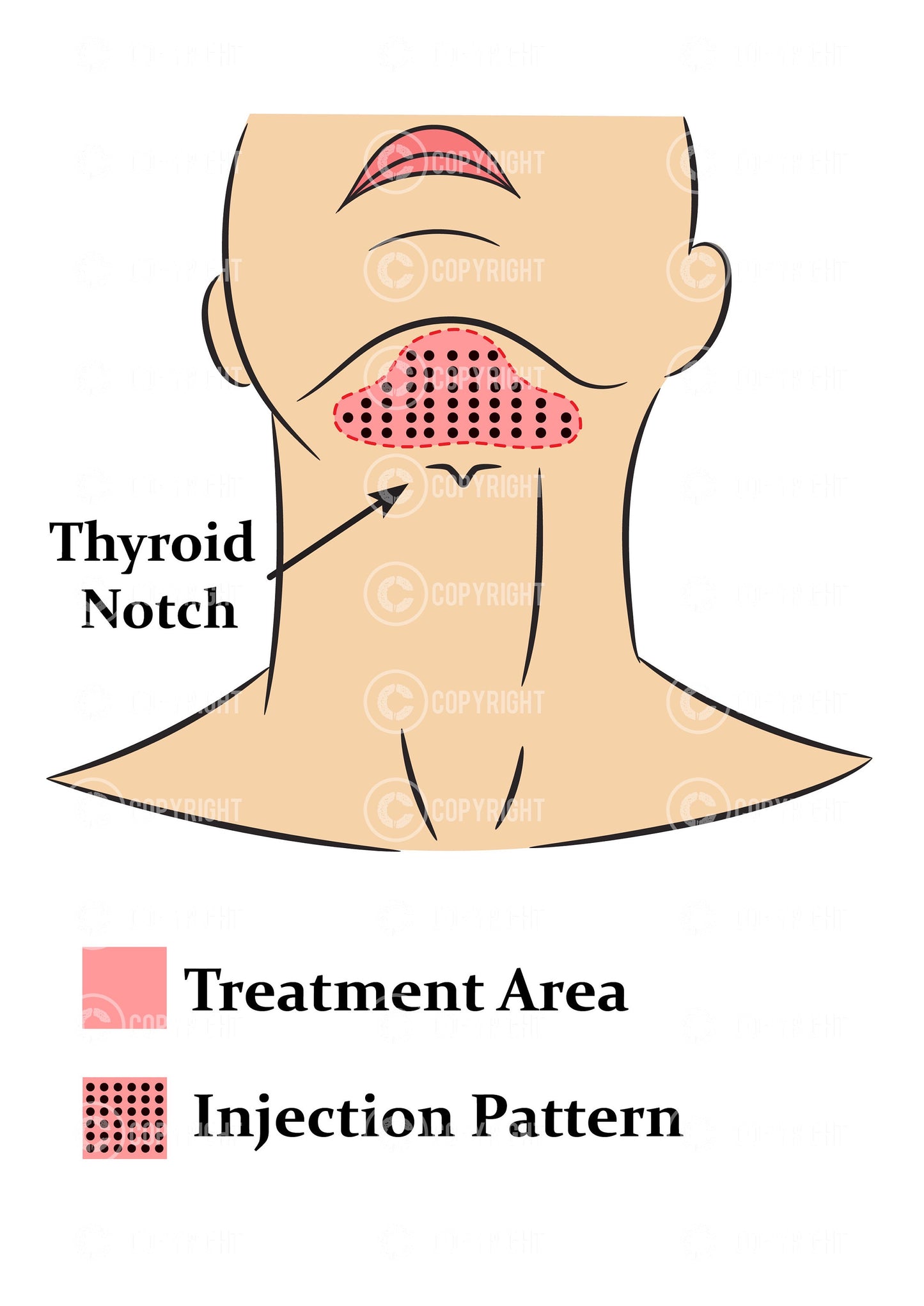 Fat Dissolving injection pattern | Aqualyx | Deso | Lipolab | Botox & Filler | Anatomy | Aesthetics | Dermatology | Medspa| Digital Download