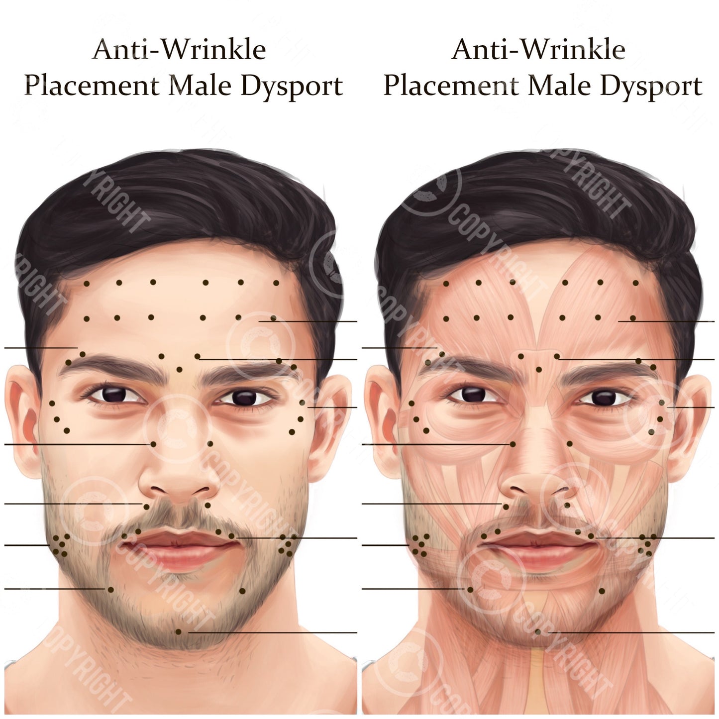 Male Dysport Injection Points Bundle | Botox & Filler Injector | Anatomy | Poster | Aesthetics | Dermatology | Medspa| Digital Download